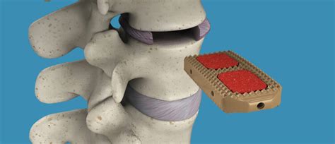 Minimally Invasive Xlif Trimed Spine Joint