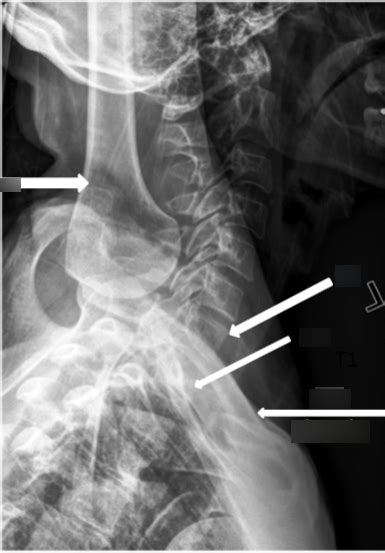 Cervicothoracic Lateral Swimmer S Diagram Quizlet