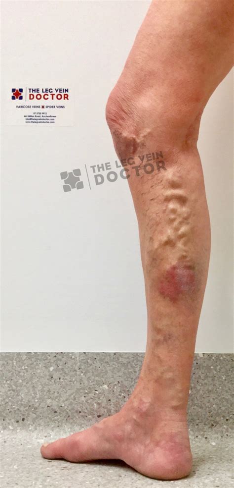 Varicose Vein Results And Post Treatment Photos — The Leg Vein Doctor