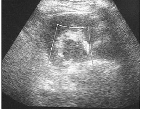 Transverse scan of the left kidney showing a hypoechoic mass with no... | Download Scientific ...