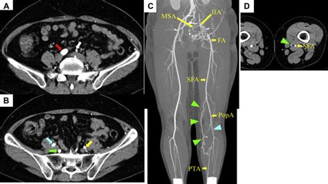 Congenital Absence Of Left Common And External Iliac Arteries Journal