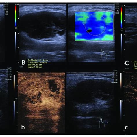 Malignant Parotid Gland Lesion Squamous Cell Carcinoma Metastasis Download Scientific