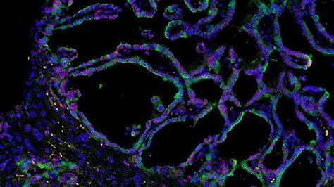 Scientists Reveal a New Therapeutic Vulnerability in Pancreatic Cancer ...