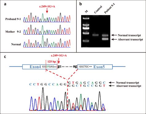 Mutation Analysis For Patient 9 1 A A Splicing Mutation C 249 1G A