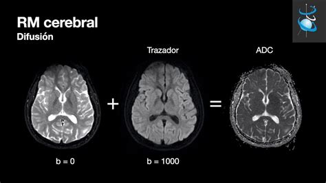 Rm Cerebral Parte Secuencias B Sicas Youtube