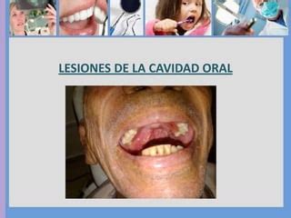 Lesiones De La Cavidad Oral PPT Descarga Gratuita