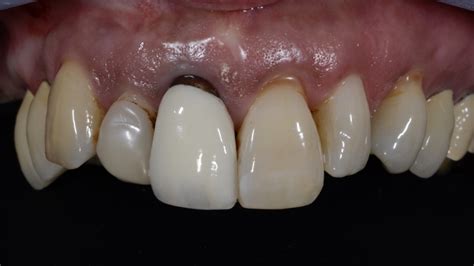 Right Central Incisor Discolored Brown Root White Implants