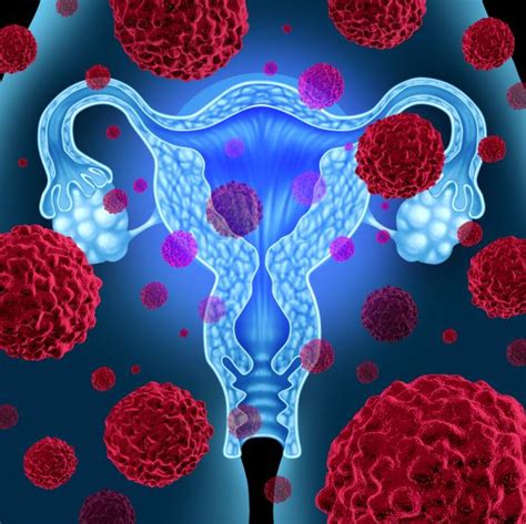 An Overview Of Endometrial Cancer Womb Cancer Uterine Cancer