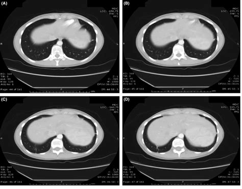 Hrct Scan Made 12 Months Later With Complete Resolution Of The