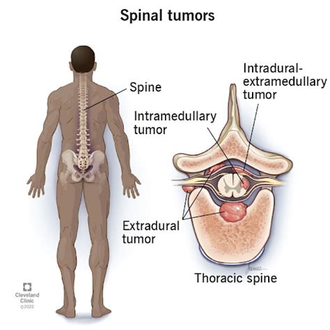 Spinal Tumors Types Causes Surgery Treatment And Cost