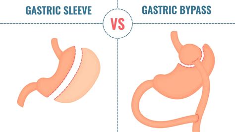 Introduction Of Bariatric And Metabolic Surgery Surgical Care Hong Kong