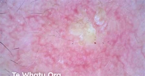 Actinic Keratosis Image