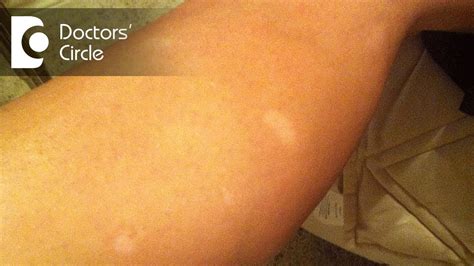 What Are The Small Light Spots On My Legs | Americanwarmoms.org