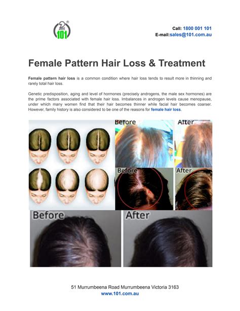 Female Pattern Hair Loss & Treatment by 101skincare - Issuu