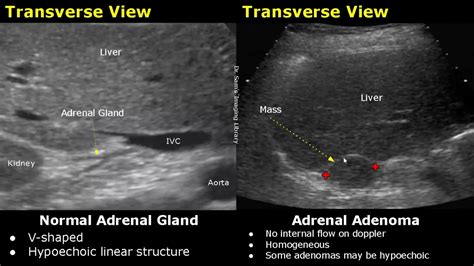 Left Adrenal Gland Adenoma