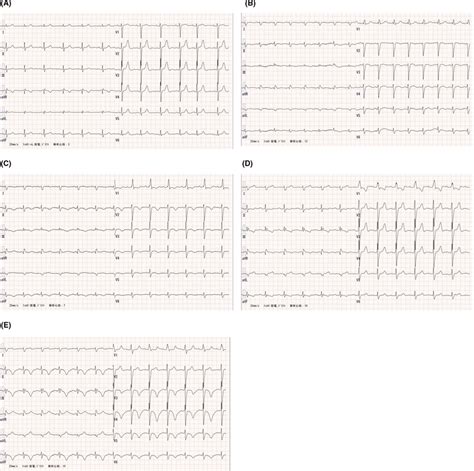 Electrocardiogram on baseline (A), on acute heart failure (B), after ...