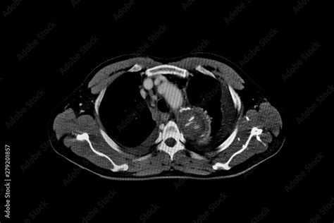 Computer Tomography Angiography Cta Of Whole Body Scan With 3d Reconstruction Ct Angiography