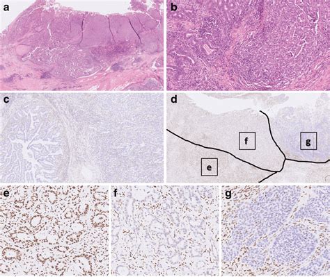 Microsatellite Instability Msi Associated Dedifferentiation Like