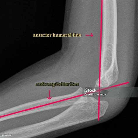 Anterior Humeral Line And Radiocapitellar Line Elbow X Ray Stock Photo