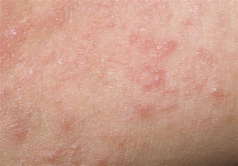 Dry Bumpy Rash