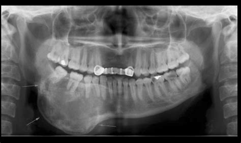 Caso N° 205 Probable Fibroma Osificante Juvenil Cdi Perú