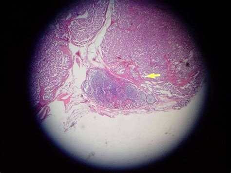 Congo Red Staining Of Lymph Node Show Stromal Amyloid Deposition