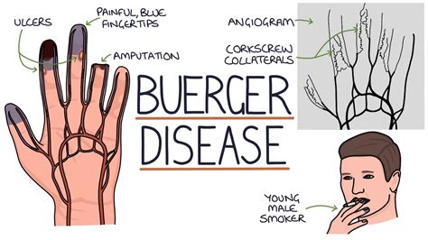 Understanding Buerger Disease (Thromboangiitis Obliterans) - YouTube