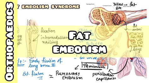 Fat Embolism Syndrome Simplified For Usmle Nclex Neet Pg Inicet