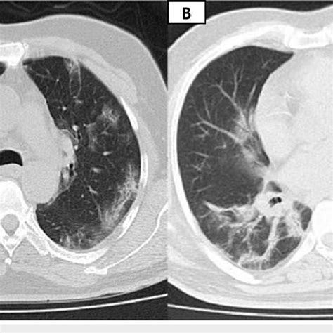 A High Resolution Computed Tomography Chest Showing Ground Glass