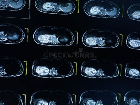 Mri Van Thoracolumbar Wervelkolom Matig Tot Ernstig Compressiefractuur