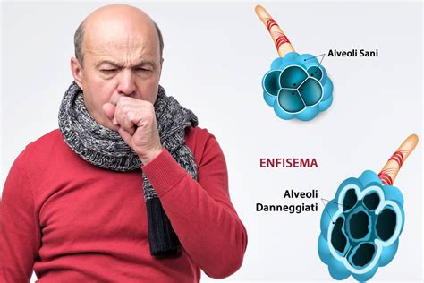 Enfisema Polmonare Cause Sintomi Cure Rimedi