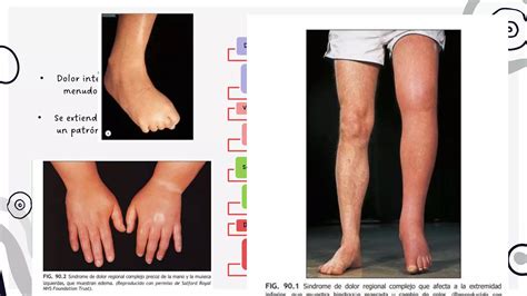 S Ndrome De Dolor Regional Complejo Pptx