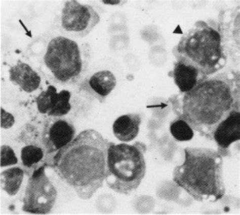 Malignant Histiocytosis In Leukemic Phase Case Report And Review Of