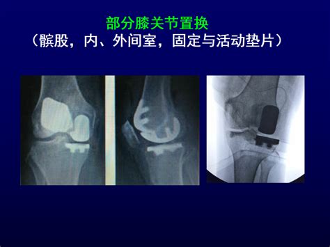 单髁置换术治疗膝关节骨性关节炎 好医术早读文章 好医术 赋能医生守护生命