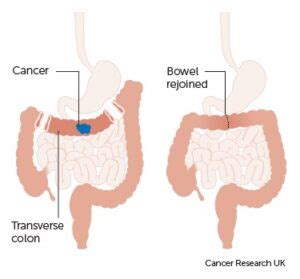 Colectomy - The Operative Review Of Surgery