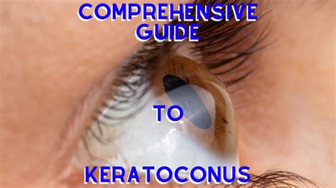 Comprehensive Guide To Keratoconus