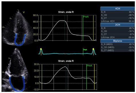 What Strain Analysis Adds to Diagnosis and Prognosis in Heart Failure