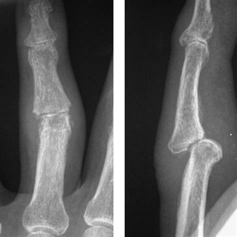 PIP Joint Pyrocarbon Implant Arthroplasty - Thomas R. Hunt III, M.D., D.Sc.