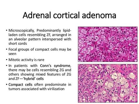 Adrenal Gland Diseases And Tumors