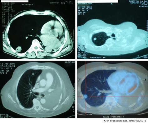 Tratamiento Quirúrgico De Lesiones Pulmonares En Pulmón único