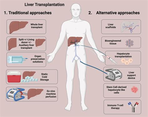 Liver Transplant Diagram