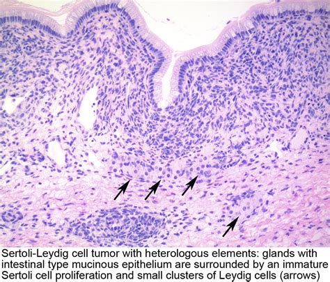 Pathology Outlines Sertoli Leydig Cell Tumor