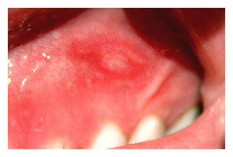 Oral Manifestations Of Crohn’s Disease A Case Report And Review Of The Literature Woo 2015