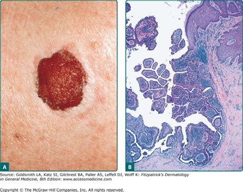 Hidradenoma Papilliferum Clinical