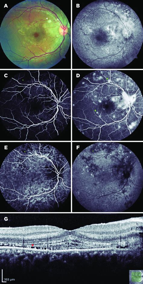 Multimodal Imaging Of The Right Eye Hours After Delivery A Fundus