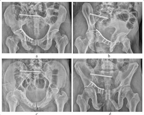 Postoperative X Ray Images Of Case A Pelvic Anteroposterior X Ray