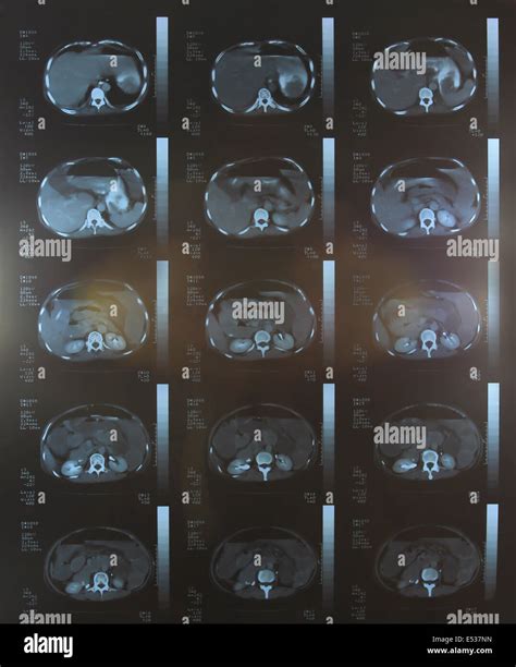 Ct scan abdomen hi-res stock photography and images - Alamy