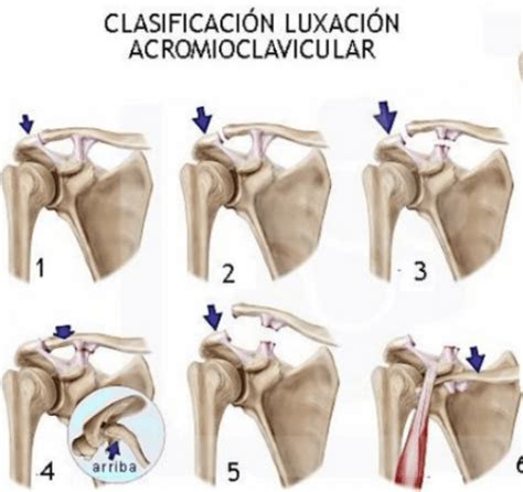 Luxaci N Acromioclavicular Causas Diagnostico Y Tratamiento