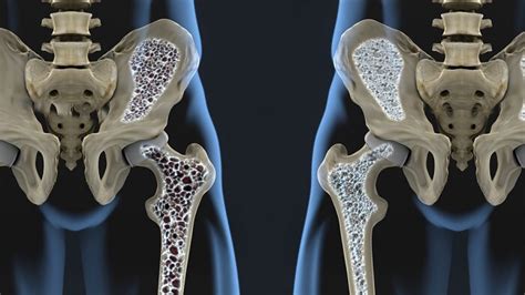 Osteopenia Causas Síntomas Diagnóstico Tratamiento Prevención