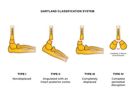 Supracondylar Fracture Types